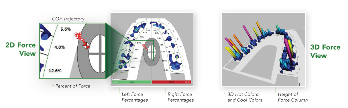 With T-Scan Novus Core, dentists can identify high forces on specific teeth by observing tooth percentages.