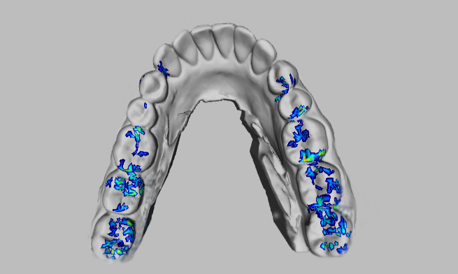 T-Scan 9.0 allows you to import digital impressions from intraoral scanners