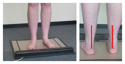 Lower Limb Alignment