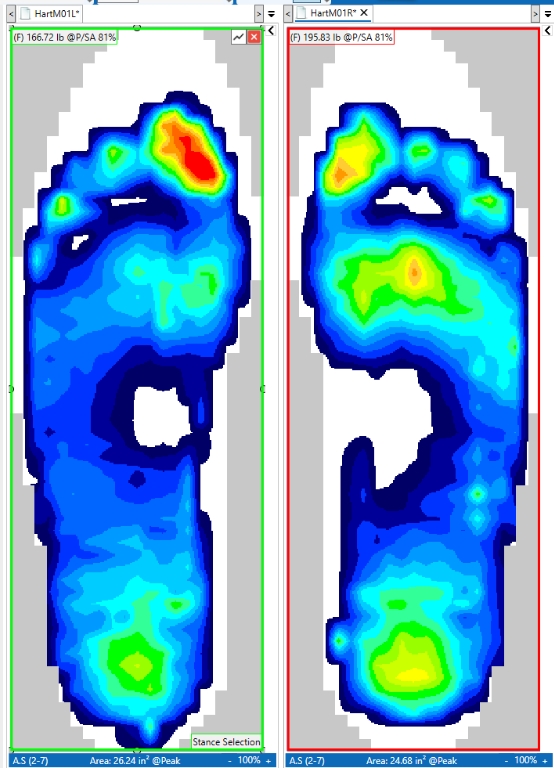 The ability to segment the foot for detailed analysis is one difference from a force plate.