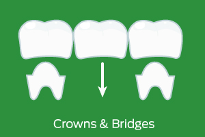 crowns and bridges