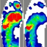 Dr. Rion Berg of Seattle Washington shares how he uses F-Scan to evaluate foot ulcers.