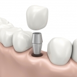 Improving Implant Surgical and Prosthetic Outcomes with T-Scan